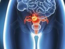 33岁多囊试管一般采用什么方案？