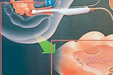 2026在咸宁市做基因检测多少钱？基因筛查可以规避哪些遗传病？